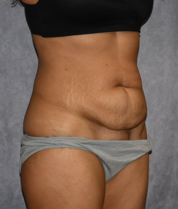 Tummy Tuck