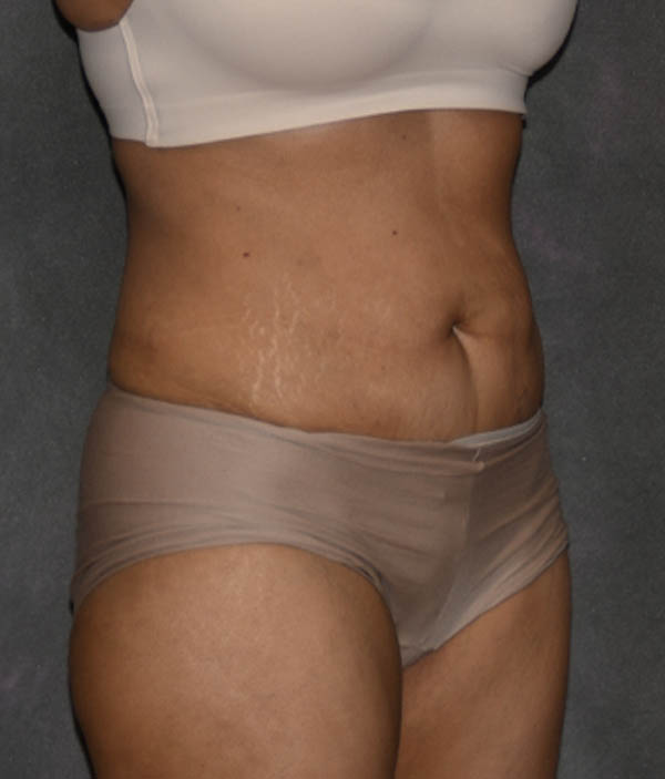 Tummy Tuck