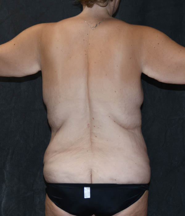 Breast Lift