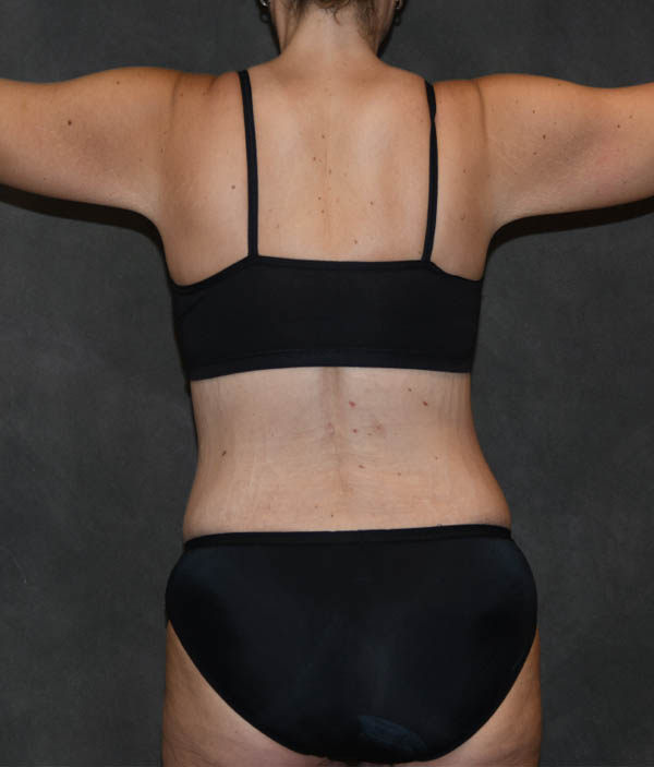 Breast Lift