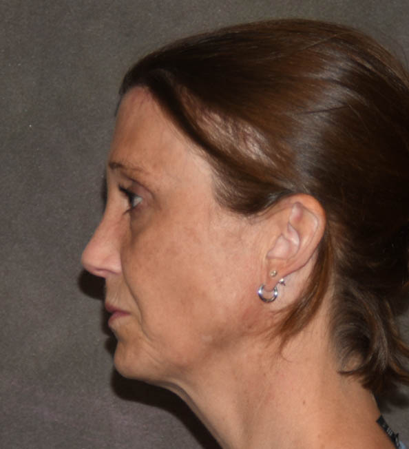 Browlift
