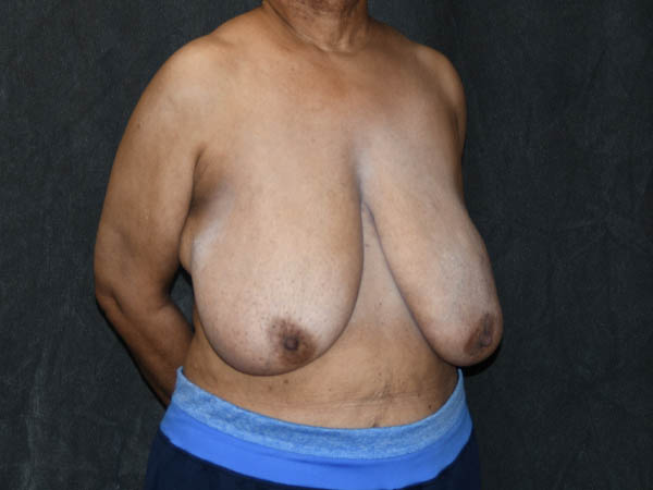 Breast Reduction