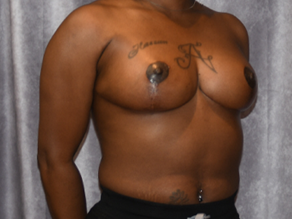 Breast Reduction