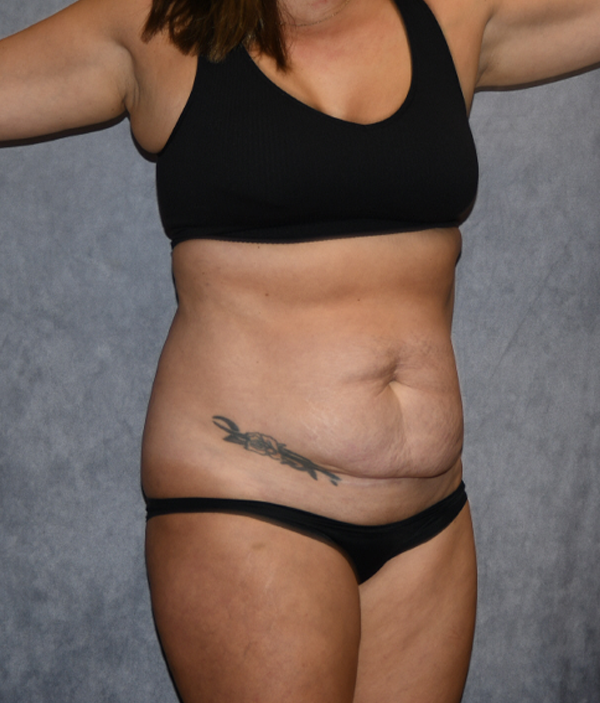 Tummy Tuck