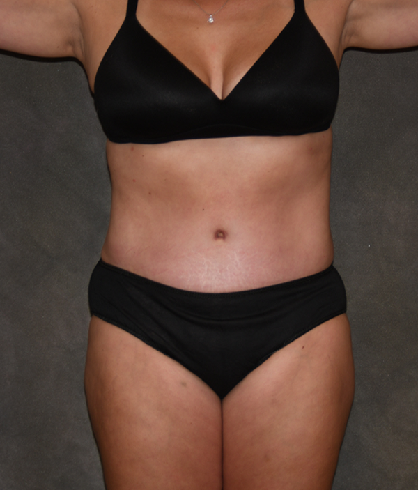 Tummy Tuck