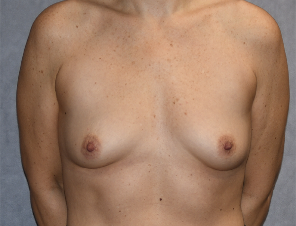 Breast Augmentation