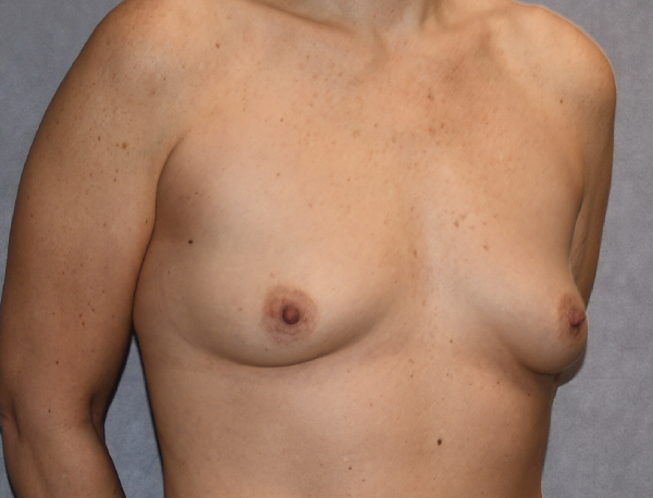 Breast Augmentation