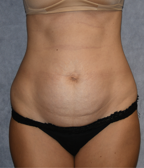 Tummy Tuck
