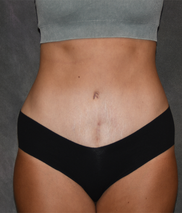Tummy Tuck