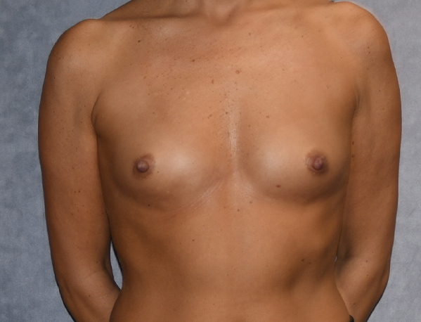 Breast Augmentation