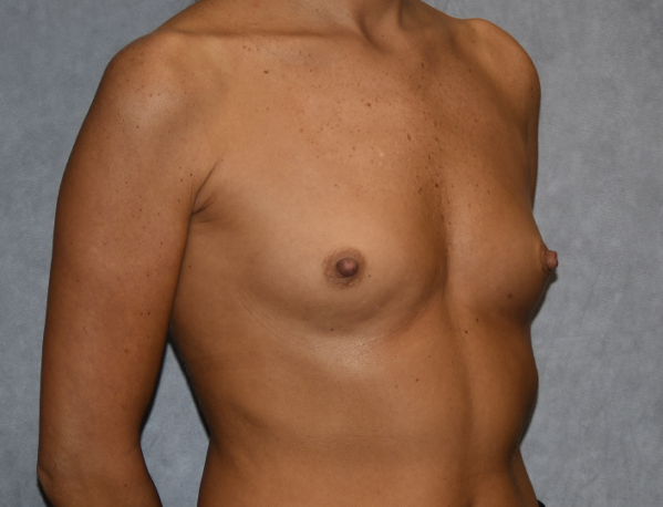 Breast Augmentation
