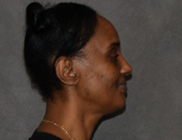 Rhinoplasty