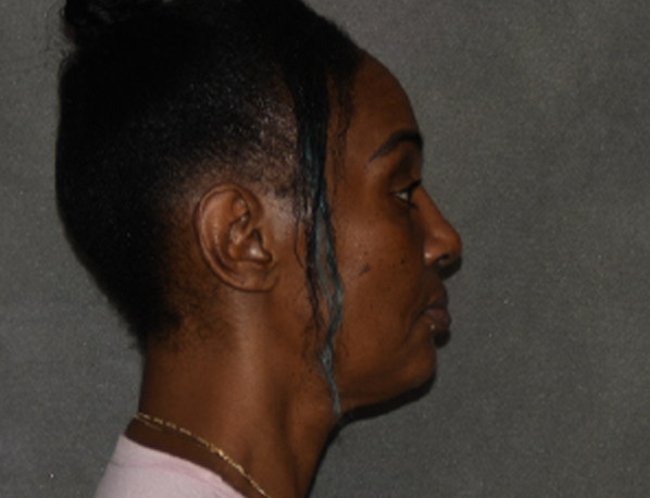 Rhinoplasty