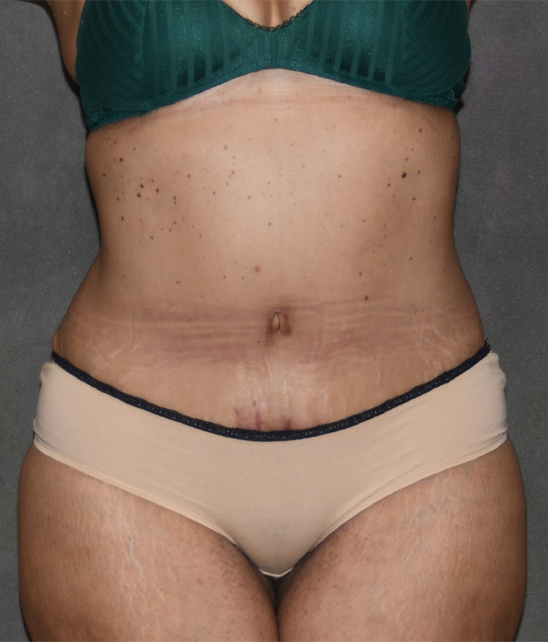 Tummy Tuck