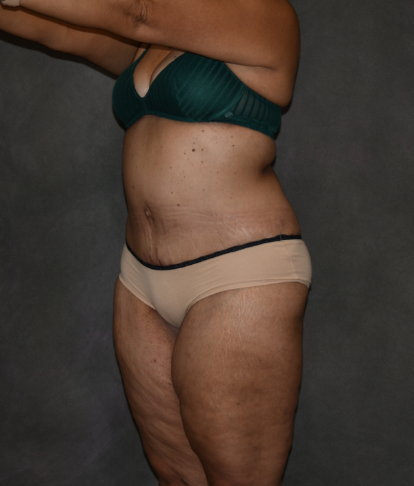Tummy Tuck