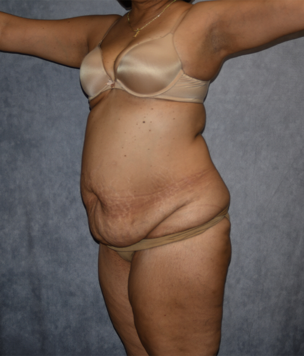 Tummy Tuck