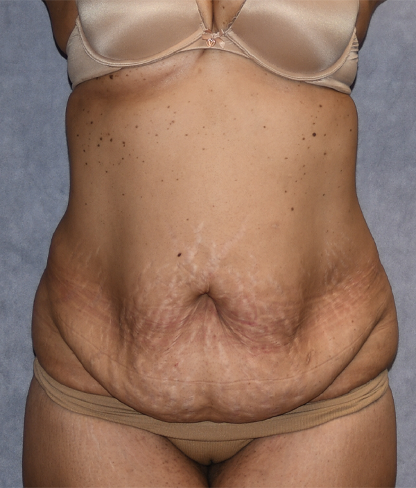 Tummy Tuck